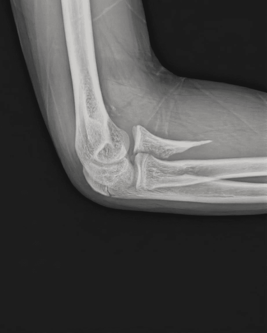 X-ray of Vivan’s fractured elbow